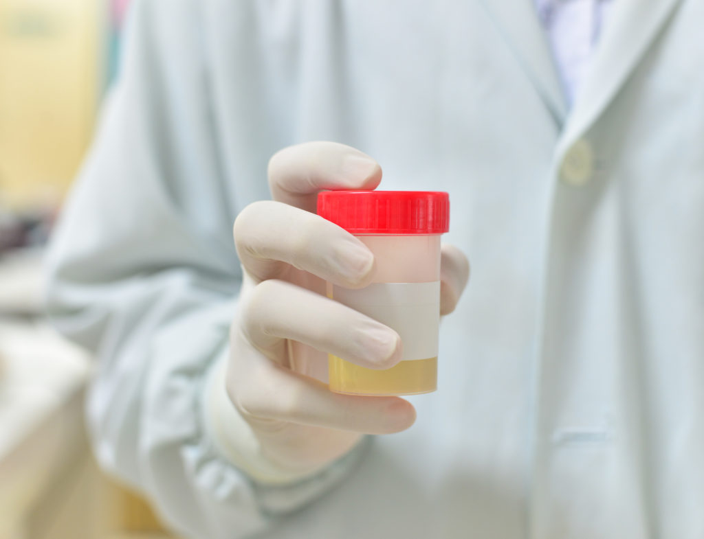 Urine Drug Test vs. Saliva Drug Test 